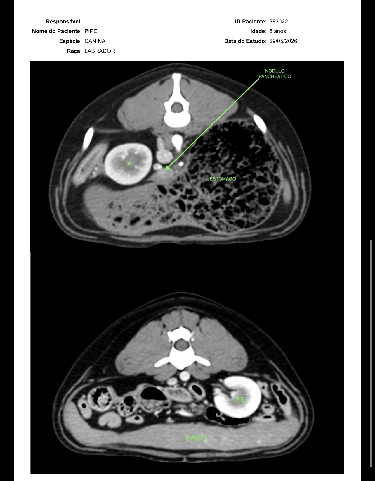 Imagem da tomografia — nódulo pancreático